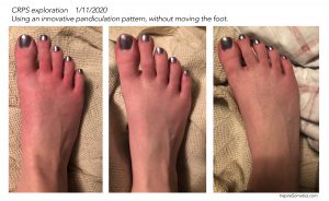 CRPS foot pain before and after